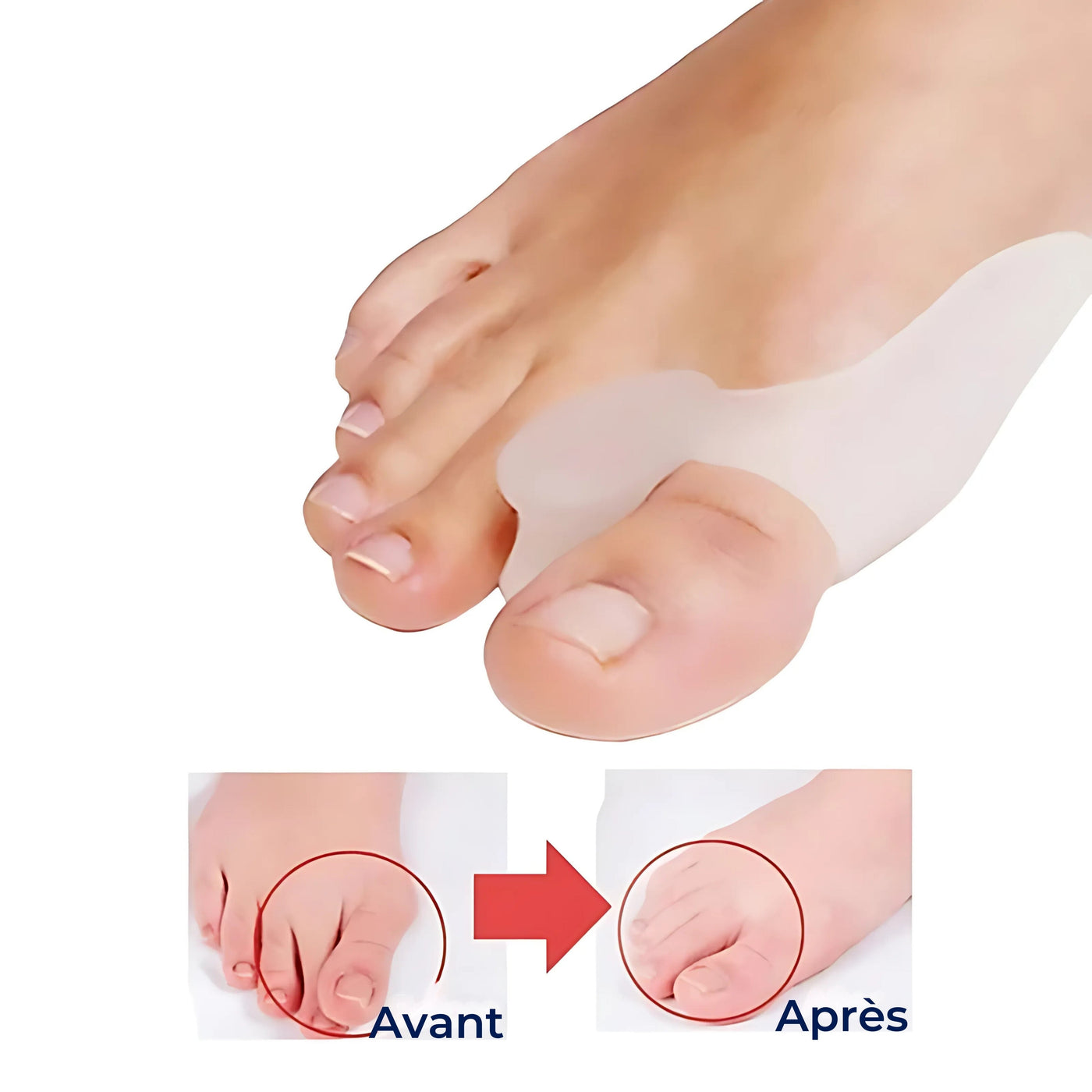 BunionGuard Hallux Valgus | Protection en silicone avec écarteur d’orteils – Soulagement de la douleur et alignement correctif